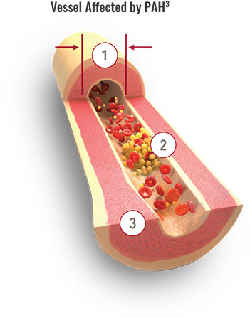 Remodulin’s mechanism of action targets vasoconstriction, platelet aggregation, and smooth muscle proliferation